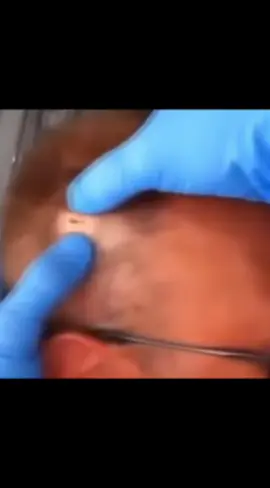#cravos #brufoli #blackhead #zit #asmr #popping #pimples_brufoli_ #zits #pimples #granos #acne #popper #pimple #pimples_brufoli #granosyespinillas #pimplepop 