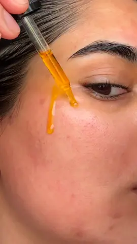 the best product for you. no more pigmentation and malasma #skincare #serum #thecustomish #malasma #turmericserum 