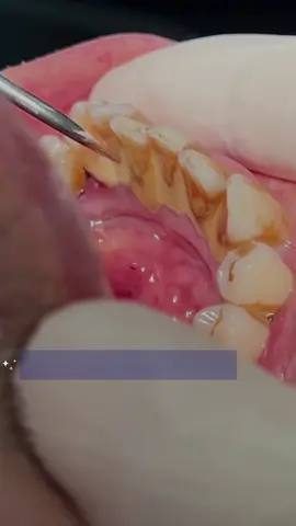 Tartar & calculus scaling #dentist #calculus #tartar #teeth #طبيب_اسنان 