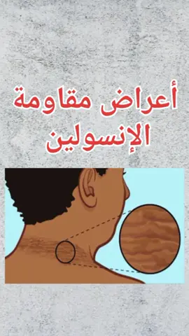 أعراض مقاومة الإنسولين #مقاومة_الانسولين #مقاومة_الأنسولين  #السكري #السكري_النوع_الثاني #صحة #صحتك 