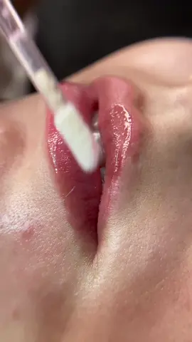 ASMR de HIDRAGLOSS ⚜️ Esse procedimento é um microagulhamento que proporciona extrema hidratação, reduz as linhas de expressões, causa um efeito pump nos labios deixando eles mais definidos e revitaliza a cor natural fos labios, ja se vê resultado logo na primeira sessão. #asmr #asmrsounds #asmrvideo #asmrtiktoks #asmrestetica #asmrhidragloss #hidragloss #estetica 