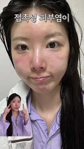 꼭 알아야 할 민감성 피부의 접촉성 피부염 극복방법🚨🚨 #민감성피부 #여드름피부 #접촉성피부염 #피부염 #피부염연고 #피부염크림 #피부관리 #피부염크림 #피부관리추천 