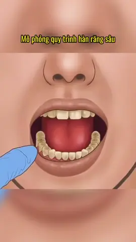 Mô phỏng quy trình hàn răng sâu tại nha khoa. Tranh thủ đi hàn răng trước Tết Nguyên Đán thuiiii #hanrangthammy #hanrangsau #nhakhoauytin 