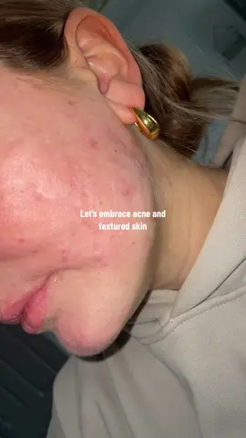 Lets show the world acne and textured skin is normal and BEAUTIFUL!!! It makes us human❤️ #texturedskin #acne #acneisnormal #acnefighter #acneskin #acneproneskin #acnepositivity #acneisbeautiful #acneconfidence 