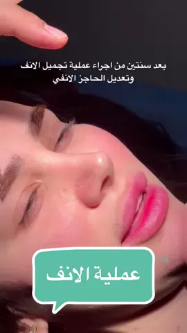 بعد سنتين من عملية تجميل الأنف وتعديل الحاجز الانفي تحت التخدير الموضعي للانف اللحمي 😍 ‏. ‏. ‏. ‏⁧#الرياضض⁩ ⁧#السعوديةة⁩ ⁧#لغلوغغ⁩ ⁧#شفطط⁩ ⁧#اللغلوغغ⁩ ⁧ ⁩ ⁧#اكسبلورر#شفط_اللغلوغغ#شفط_اللغلوغ_بالفيزرر#شفط_اللغلوقهه #جراحة_تجميلل⁩ ⁧#عنايةة⁩ ⁧#نضارةة⁩ ⁧#عروضض⁩ ⁧#تجميل_الانفف⁩ ⁧#شفط_الدهونن⁩ ⁧#حقن_الدهونن⁩ ⁧#الرياض_الآنن⁩ ⁧#مشاهيرر⁩ ⁧#مشاهير_العربب⁩ ⁧#عروضض⁩ ⁧#خصوماتت⁩ ⁧#فيزرر⁩ ⁧#زراعه_شعرر⁩ ⁧#تثدي_الرجالل⁩ ‏⁧#عروضض⁩ ⁧#مسابقةة⁩ ⁧#خصوماتت⁩ ⁧#تجميلل⁩  ⁧#مشاهيرر⁩ ⁧#عنايةة⁩ ⁧#نضارة_الوجهه⁩ ⁧#جراحةة⁩ ⁧#تجميلل⁩ ⁧#تجميل_الانفف⁩ ⁧#شفط_الدهونن⁩ ⁧#حقن_الدهونن⁩ ⁧#فيزرر⁩ ⁧#تثدي_الرجالل⁩ ⁧#فيلرر⁩ ⁧#بوتكسس⁩ ⁧#وصفاتت⁩ ⁧#المملكة_العربية_السعوديةة⁩ ⁧#اخبارالسعوديةة#moroccoo#algeriaa#saudiarabiaa#dubaii#kuwaitt#dohaa#jeddahh#fypシシ#fypシ゚virall#foryouu#foryoupagee#explorepagee#exploree#rinoplastiaa#rinoo #burundolgusuu#rinoplastyy#rinoplastikaa 
