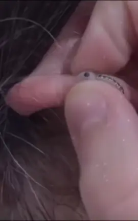#cravos #brufoli #blackhead #zit #asmr #popping #pimples_brufoli_ #zits #pimples #granos #acne #popper #pimple #pimples_brufoli #granosyespinillas #pimplepop 