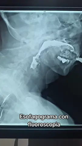 Esofagograma ☢️🖤  #radiology #fluoroscopy #medicine #imagenologia 