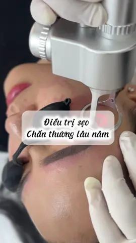 Điều trị sẹo chấn thương lâu năm. Điều trị sẹo #tedclinic #tedbeautyclinic #laser #trắngda #TrịSẹoTrắng #VùngMắt 