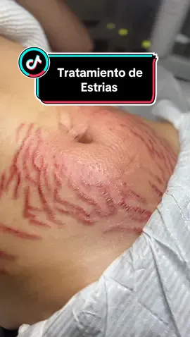 ⚡️Miren esta asombrosa transformación de el Tratamiento de estrías con Plasma fibroblast. El tratamiento de regeneración de estrías con plasma fibroblast es una técnica que utiliza la energía del plasma para estimular la regeneración de la piel y mejorar la apariencia de las estrías. El plasma fibroblast es un dispositivo médico que emite pequeñas descargas eléctricas en la superficie de la piel, lo que provoca una contracción de los tejidos y estimula la producción de colágeno y elastina. Este tratamiento puede ayudar a reducir la apariencia de las estrías al mejorar la textura de la piel y promover la regeneración celular. Sin embargo, es importante tener en cuenta que los resultados pueden variar según cada persona y el grado de las estrías. Es fundamental consultar con un profesional especializado. Reserva tu Cita: 📅 Trabajamos exclusivamente con citas. 🔒 Se requiere un depósito de $50 para asegurar tu espacio Zelle Novabelle Spa 214-309-8224 Cómo Contactarnos: 📲 Texto: 214-309-8224 📨 Inbox: [Facebook] Novabelle Spa 🎆 Instagram: Novabelle.studio 📍 Dirección: 4004 Belt Line Rd #130, Addison, TX 75001 #viral #fyp #plasmafibroblast 