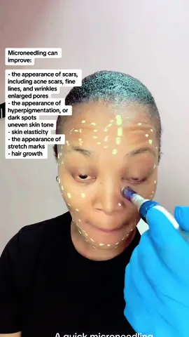 Microneedling can improve: - the appearance of scars, including acne scars, fine lines, and wrinkles enlarged pores - the appearance of hyperpigmentation, or dark spots uneven skin tone - skin elasticity - the appearance of stretch marks - hair growth  #microneedling #chemicalpeel #chemicalpeeljourney #acne #acnetreatment #phemoclinic 