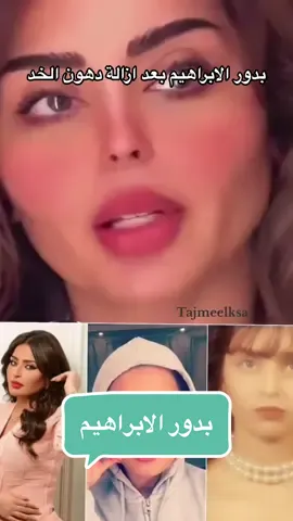 بدور الابراهيم بعد ازالة دهون الخد 😍 ‏. ‏. ‏. #بدور_الابراهيم ‏⁧ #الرياض⁩ ⁧ #السعودية⁩ ⁧ #لغلوغ⁩ ⁧ #شفط⁩ ⁧ #اللغلوغ⁩ ⁧ ⁩ ⁧ #اكسبلور⁩#شفط_اللغلوغ #شفط_اللغلوغ_بالفيزر #شفط_اللغلوقه  #جراحة_تجميل⁩ ⁧ #عناية⁩ ⁧ #نضارة⁩ ⁧ #عروض⁩ ⁧ #تجميل_الانف⁩ ⁧ #شفط_الدهون⁩ ⁧ #حقن_الدهون⁩ ⁧ #الرياض_الآن⁩ ⁧ #مشاهير⁩ ⁧ #مشاهير_العرب⁩ ⁧ #عروض⁩ ⁧ #خصومات⁩ ⁧ #فيزر⁩ ⁧ #زراعه_شعر⁩ ⁧ #تثدي_الرجال⁩ ‏⁧ #عروض⁩ ⁧ #مسابقة⁩ ⁧ #خصومات⁩ ⁧ #تجميل⁩  ⁧ #مشاهير⁩ ⁧ #عناية⁩ ⁧ #نضارة_الوجه⁩ ⁧ #جراحة⁩ ⁧ #تجميل⁩ ⁧ #تجميل_الانف⁩ ⁧ #شفط_الدهون⁩ ⁧ #حقن_الدهون⁩ ⁧ #فيزر⁩ ⁧ #تثدي_الرجال⁩ ⁧ #فيلر⁩ ⁧ #بوتكس⁩ ⁧ #وصفات⁩ ⁧ #المملكة_العربية_السعودية⁩ ⁧ #اخبارالسعودية⁩#morocco #algeria #saudiarabia #dubai #kuwait #doha #jeddah #fypシ #fypシ゚viral #foryou #foryoupage #explorepage #explore #rinoplastia #rino  #burundolgusu #rinoplasty #rinoplastika 