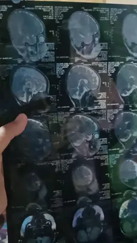 17, Januari 2024MRI,scen kepala dd meiyan NATASYAH😭baru dapet hasil,tp blom dibacakan,tgl6,kontrol ke dsa br dibacakan,#pejuang_Cerebral_palsy