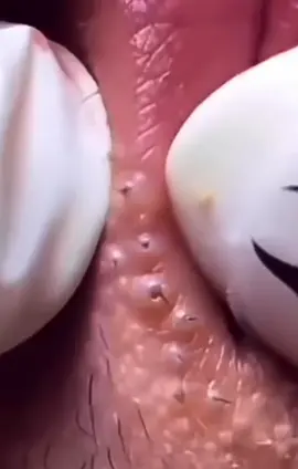 Wooow!! #granosyespinillas #viral #satisfyingvideo #satisfaction #satisfying #fyp #pimplepop #pimple #filamentossebaceos #acne #puntosnegros #granos #parati #CleanTok #limpiezafacial #foryou 