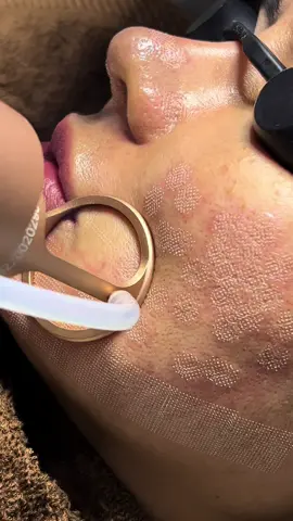 Laser terbaik dunia yang bisa buat wajah kamu kembali mulus 😍 #laserco2 #co2fractional_laser 