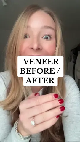 my before & after #veneers | dedicated to being as trasparent as possible. This is something that I considered for 10+ years. Please do not leave here thinking you also need them just because you saw this. I do not want my insecurity to become yours. Make descisions with yourself and for yourself ❤️