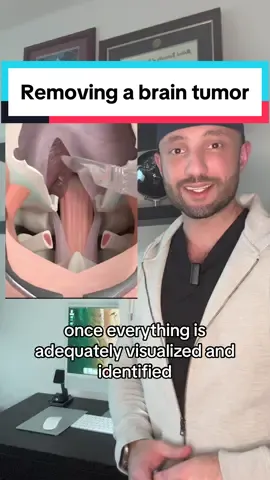 This is how brain tumors are removed from the posterior fossa. #brainsurgery #neurosurgery #doctorexplains #surgery #chiarimalformation #braintumor #medical #medtok 