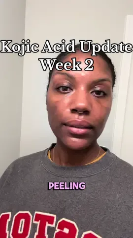 Kojic Acid Soap Bar week 2 update #kojicacid #kojicsoap #kojiesan #hyperpigmentation #melasma #darkspots @Jade 