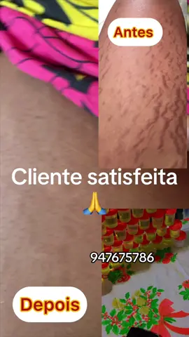 Oleo de tira varizes no corpo ta sempre disponível 