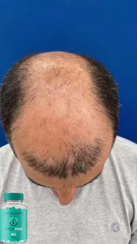 Essa calvicie estava em um grau muito avançada o grau 7 onde quase não há mais cabelo na cabeça. Logo foi recomendado o tratamento de 5 meses com o calvimax e após o período obteve esse resultado.  #tratamentocalvicie #alopecia #calviciemasculina #calvo #quedadecabelo #crescimentocapilar #calvicie #quedacapilar #autoestima 