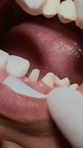 Zirconia crown #dentist #zirconia #teeth #طبيب_اسنان 