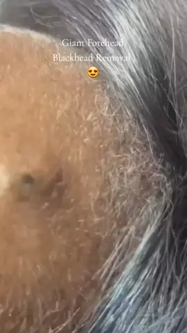 Giant Forehead Blackhead Removal So Satisfying  😍 #pimplepoppersatisfying 