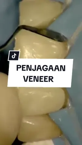 #fyp #gigi #teeth #tooth #veneer #composite #treatment #doniadentalclinic #klinikgigikelantan #klinikpergigiandonia #dentalcare 