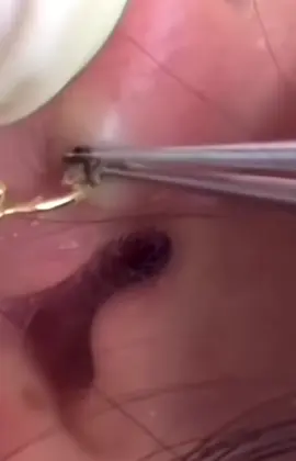 Extraccion en el agujero de la nariz! #granosyespinillas #viral #satisfyingvideo #satisfaction #satisfying #fyp #pimplepop #pimple #filamentossebaceos #acne #puntosnegros #granos #parati #CleanTok #limpiezafacial #foryou 