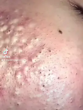 #granosyespinillas #viral #satisfyingvideo #satisfaction #satisfying #fyp #pimplepop #pimple #filamentossebaceos #acne #puntosnegros #granos #parati #CleanTok #limpiezafacial #foryou 
