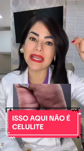 Lipedema não é celulite, é uma  doença que deve ser tratada com a orientação de uma médica integrativa! Desconforto e dor ao toque, o lipedema pode ser bem desconfortável, além de incomodar de forma estética o(a) paciente, mas com cuidado e tratamento correto acompanhado de médica integrativa, seguindo os 4 tratamentos que falo no vídeo, conseguirá solucionar esse problema. Assista até o final e comente👇 Você já conhecia o Lipedema?  Tem ou conhece quem tem Lipedema? Sua experiência ajuda outras pessoas. Dra. Mariana Amalia Ginecologista CRM MS 8222 RQE 6077 Medicina Integrativa, Cirurgia Íntima à Laser, Laser Íntimo, Implantes Hormonais e Terapias Injetáveis  #dramarianaamalia #ginecologia #ginecologista #ginecologiaintegrativa #medicinaintegrativa #lipedema #sono #ms #douradosms #saopaulo 