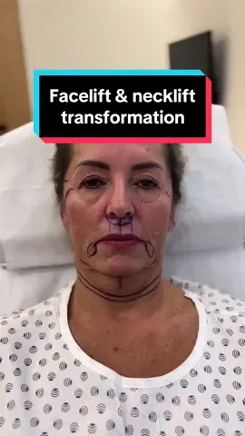 2 months after deep plane facelift, deep necklift, lip lift and lower blepharoplasty. All done in local anesthesia😊 📲 If you want to make an appointment, contact us at info@v-clinic.cz #facelift #necklift #liplift #blepharoplasty #plasticsurgery #plasticsurgeon #plastickachirurgie #transformation #beforeandafter #vclinic #ventruba 