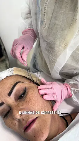 Os fios de PDO de tração oferecem diversos benefícios, tais como: 1.Reposicionamento de tecido  2.Um leve Efeito de lifting  3.Estímula produção de colágeno, o que contribui para a firmeza e elasticidade da pele. 4.Redução de rugas e linhas de expressão. 5.Contribuindo para o rejuvenescimento da pele como um todo  Esses são alguns dos benefícios. E você já agendo sua consulta avaliativa para saber qual é o procedimento adequado para você?  #esteticacampogranderj #esteticabangu #fiosdepdo #fiosdesustentacao #lifting #esteticafacil #harmonizacaofacial #curitiba #autoestima 