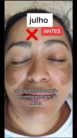 informações na bio . #protecaosolar #pele #skincare #skincare #foliculite #semrugas #skincare #useprotetorsolar #fenol #melasma #pelejovem #vitacid #peleperfeita #cicatrizes #hidrapele 