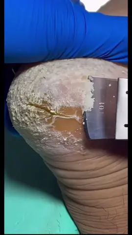 #pies #foot #hongos #piesmaltratados #piesdestrozados #plantapie #skin #feet #footpeel 