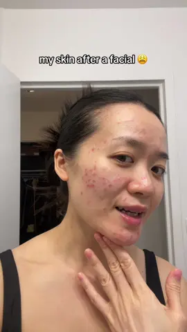 The girls who have glowing skin after a facial, how does it feel to be god’s favorite? 🙃  The redness is from the extraction tools 😩 #acneprone #cloggedpores #facialtreatment #sensitiveskin 
