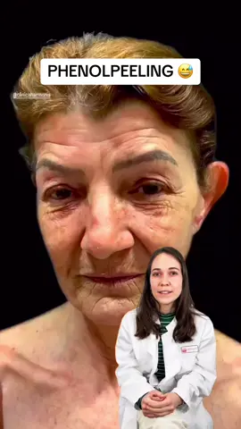 ⚠️BITTE LESEN: Bei dem Phenolpeeling, das derzeit in vielen Videos zu sehen ist,  handelt es sich um ein tiefgreifendes, chemisches Peelingverfahren, das hauptsächlich zur Behandlung schwerwiegender Hautprobleme wie tiefer Faltenbildung, Narbenbildung und schweren Sonnenschäden eingesetzt wird. Dabei wird - wie der Name schon sagt - Phenol verwendet: eine Säure, um die oberen Hautschichten gezielt zu entfernen (zu verbrennen) und damit die Hauterneuerung anzuregen. ♻️ WICHTIG: So ein Peeling birgt große Risiken, die auch unter kontrollierter Anwendung eines Arztes nicht vermieden werden können: ❌Hautschädigung: Phenol dringt sehr tief in die Haut ein und führt zu einer kontrollierten Hautverbrennung. Wenn es nicht richtig angewendet wird, kann dies zu dauerhaften Hautschäden führen.  ❌Infektionen: Da die äußere Schutzschicht der Haut entfernt wird, besteht während der Heilungsphase ein erhöhtes Risiko für Infektionen.  ❌Pigmentveränderungen: es können vorübergehende oder dauerhafte Veränderungen in der Hautfarbe verursachen, insbesondere bei Menschen mit dunklerer Haut. ❌Schmerzen und Beschwerden: Nach einem Phenolpeeling kann es zu starken Schmerzen, Schwellungen und Beschwerden kommen, die einige Wochen anhalten können.  ❌Narbenbildung: In seltenen Fällen kann es zu Narbenbildung kommen, insbesondere wenn die Anwendung nicht ordnungsgemäß durchgeführt wird oder die Haut nicht richtig heilt. ❌ Lichtempfindlichkeit: Nach einem Phenolpeeling kann die Haut sehr empfindlich gegenüber Sonnenlicht sein, was das Risiko von Sonnenbrand und Pigmentveränderungen erhöht.  Wir raten persönlich von so einem Peeling ab - es gibt viele verschiedene, risikofreie und gesunde Wege, die Haut frisch zu halten. Und das schönste Geschenk für die Haut & die Seele ist Akzeptanz fürs schöne Älterwerden 🧡 ➡️ FOLGE UNS für mehr Wissen von A-Z rund um unser größtes Organ und BESUCHE UNS in unserer Online-Hautarztpraxis per App (erhältlich für Android & iOS📲🧡 #phenolpeeling #antiaging #aknenarben #peeling #faltenfrei