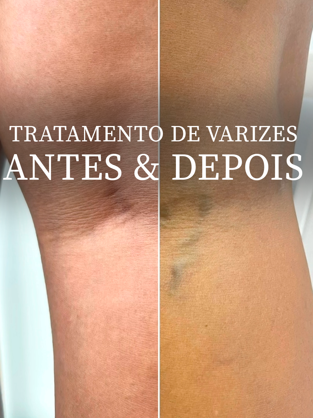 Antes e Depois de Tratamento de Varizes!  #TratamentodeVarizes #PernasLindas #VarizesNuncaMais
