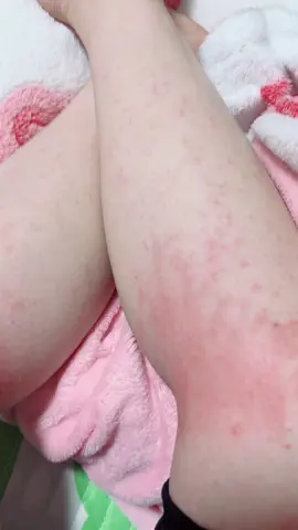 Gần 5 năm ở nhật lần đầu tiên da bị ntn , có phải dị ứng thời tiết ko mng, em ngứa sắp điên cả người rồi😫😫😫 30 tết ơi😰😰