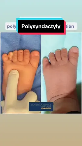 Hi 👋🏼 everyone!  Seen here is my sweet 🥰 patient ONLY 1 month following lower extremity 🦶🏻polysyndactyly reconstruction.  Surgical repair is typically performed before ambulation, and a long  leg cast is placed for approximately 10 days. Dressing changes are carried out by parents for 1-2 weeks followed by webspace taping for up to 1 year post-op.  Patients are followed yearly to evaluate function. Leave your questions in the comments below.👇🏼  #polysyndactyly #syndactyly #gardencity #babylon #nyc #longisland