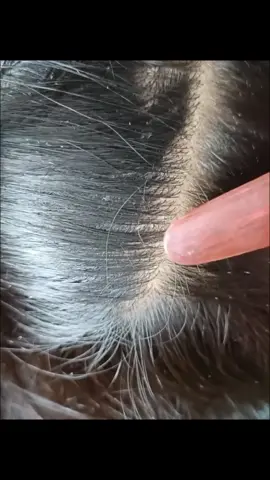 OMG😱😱😱 Lice.#tick #lice #foryou #parasite #fypシ #viral #viralvideo 