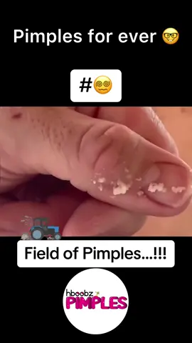 #pimple #medical #horror #blackhead #bigpimple #pimpleremoval #disgusting #pimplepop #cystexplosion #squeeze #squeezeyuk #skincare #acnetreatment #acne #pimples #satisfying #whiteheads #abscess #verysatisfying #cyst 