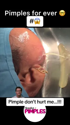 #pimple #acne #skin #skincare #skincareroutine #medical #satisfying #videoviral #squeezeyuk #amazing #viral #pimplepop #bigpimple #pimpleremoval #acnetreatment #squeeze #cystexplosion #horror #blackhead #disgusting 