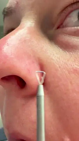 What do we think? #pimple #fyp #satisfying #pop 
