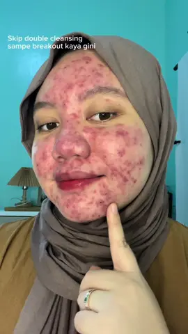 Sebagus itu kalau Pakai Micellar Cleansing Water dari @Garnier Indonesia  Micellar Water yang aman banget di kulit sensitive aku! #YakinUdahBersih #GarnierMicellarTuntasBersihkan #skin 