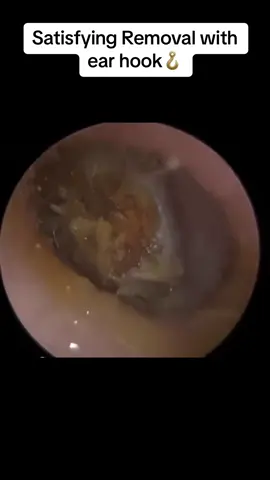 #capcut #earwax #fyp #satisfying #earwaxremoval #earwaxcleaning #earcleaning #tiktok 