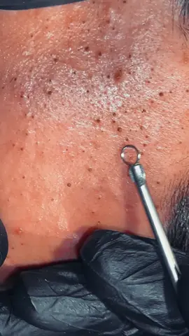 beautiful comedones and Whiteheads Extraction #pimplepoppersatisfying #pimple #acne #whiteheads 