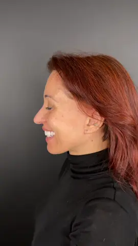 2 months after #facelifting 