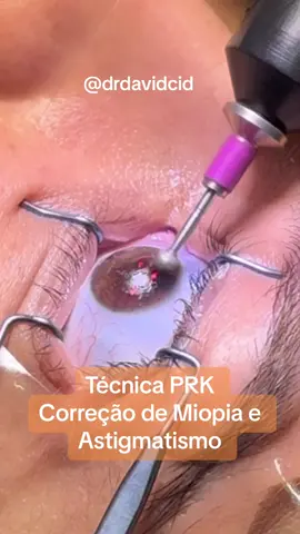 #oftalmologistaemfortaleza #cirurgiarefrativa #cirurgiarefrativaalaser #oftalmologista #oftalmologista #miopia #astigmatismo 