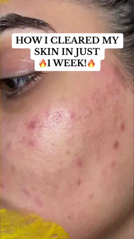 How i cleared my skin in 1 week!🔥 #foryoupage #foryou #trending #skin #skincare #clearskin #acne #acneskin #asiangirl #desi 