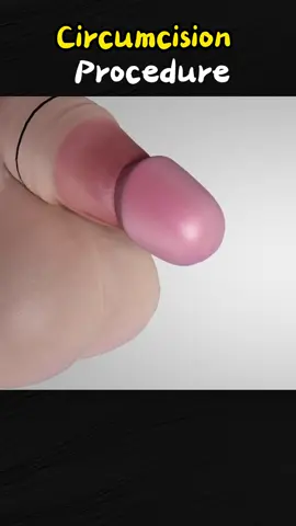 Circumcision Procedure! 😨 #circumcision #circus #plastic #peni #cutting #correct #shape #shocked #medicalprocedure #😍😱😱😱♥️ 