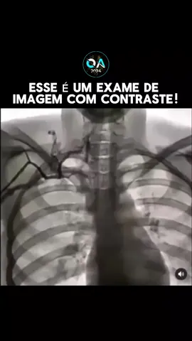 Um exame de imagem com contraste é um procedimento em que um agente de contraste é utilizado para obter imagens mais detalhadas de uma área específica do corpo. O contraste pode ser administrado de diferentes formas, como por injeção intravenosa ou ingestão oral. Uma vez que o contraste tenha sido administrado, o paciente é posicionado corretamente para o exame e as imagens são capturadas utilizando equipamentos de imagem, como ressonância magnética ou tomografia computadorizada. As imagens são então analisadas por um médico especialista, que emitirá um relatório com as conclusões do exame. É importante mencionar que existem riscos associados aos exames de imagem com contraste, como reações alérgicas, e é essencial informar ao médico sobre quaisquer alergias ou condições médicas antes do procedimento. #tecnologia #medicina #saude #curiosidade #obcecadoporastronomia #foryou 